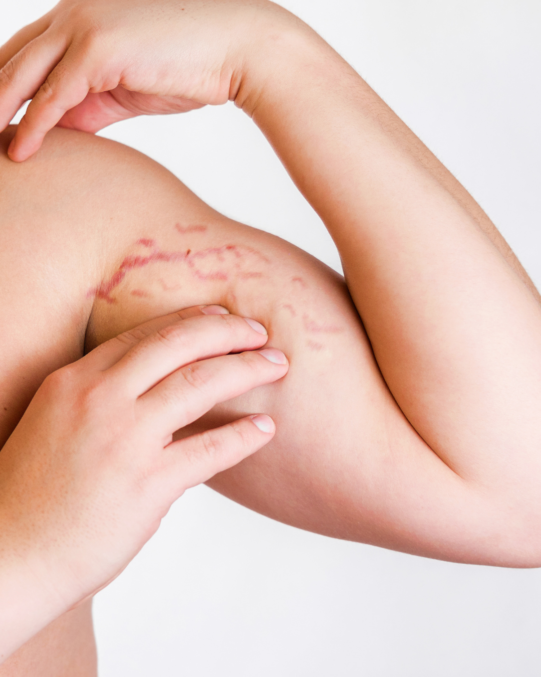 Stretch Mark Reduction Therapy Arms