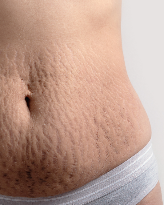 Stretch Mark Reduction Therapy Abdomen